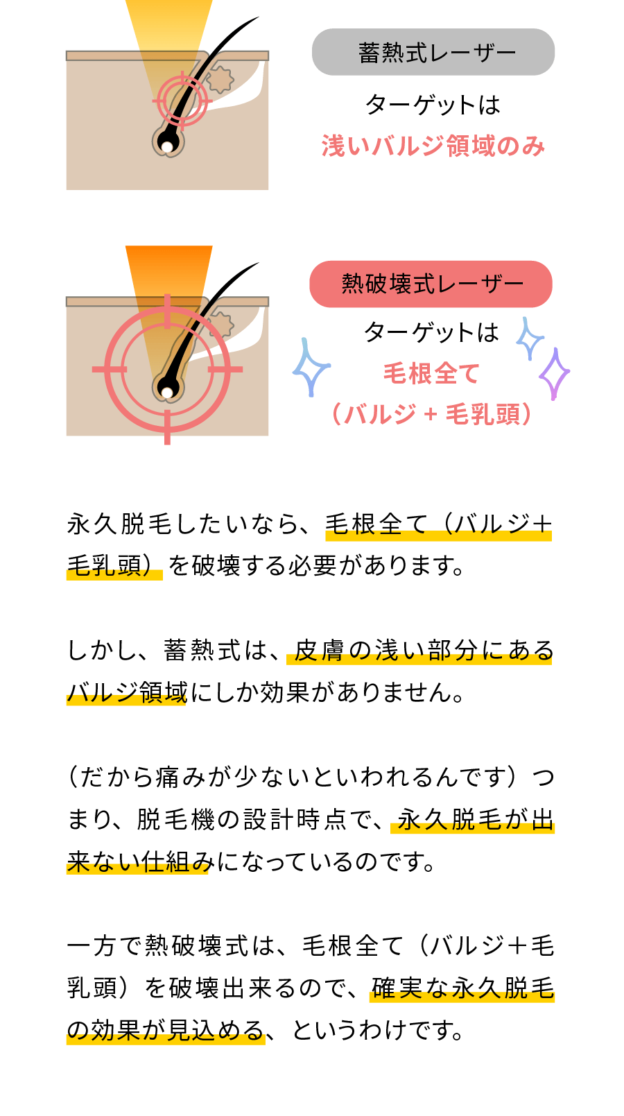 蓄熱式レーザー：ターゲットは浅いバルジ領域のみ。熱破壊式レーザー：ターゲットは毛根全て（バルジ＋毛乳頭）