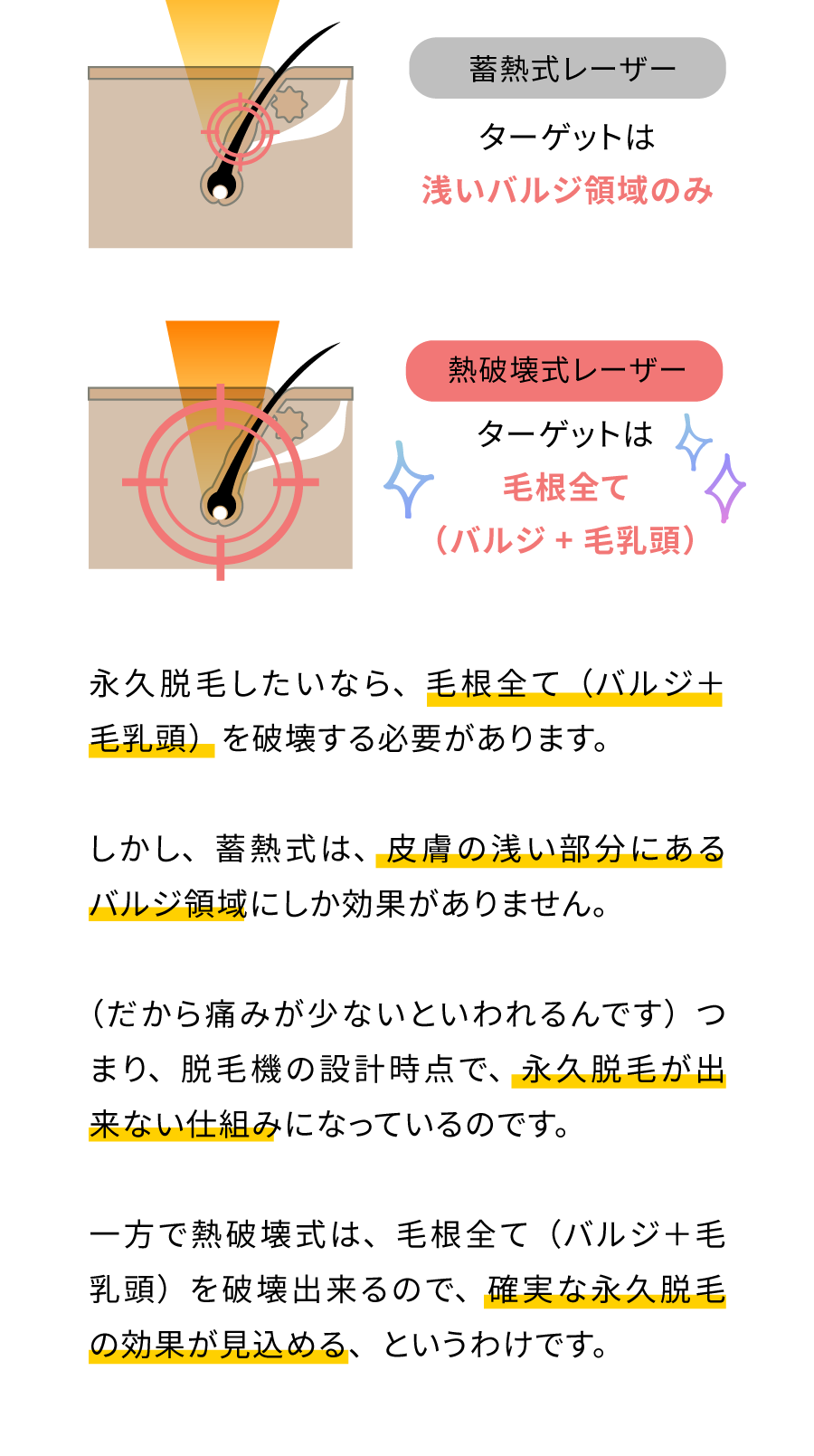 蓄熱式レーザー：ターゲットは浅いバルジ領域のみ。熱破壊式レーザー：ターゲットは毛根全て（バルジ＋毛乳頭）